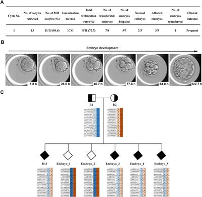 Case Report: Preimplantation Genetic Testing for Meckel Syndrome Induced by Novel Compound Heterozygous Mutations of MKS1